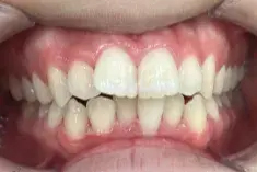 ガタガタ歯Before